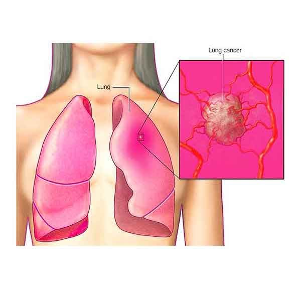 سرطان ریه چیست؟